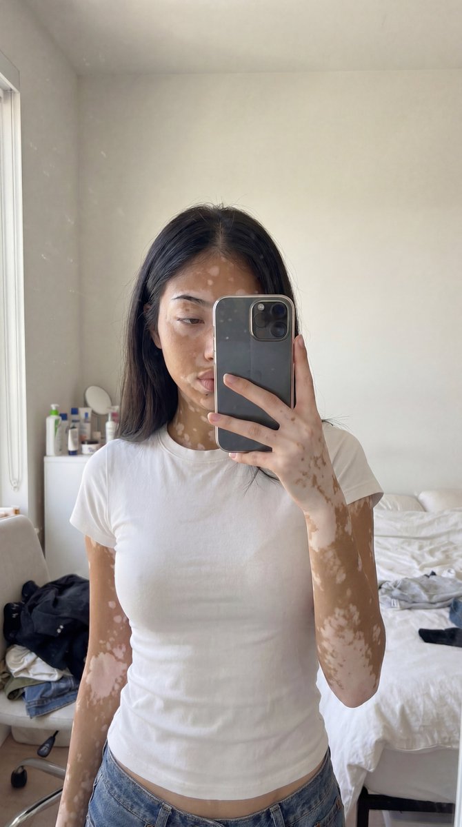 Realistic Vitiligo Skin Photography — Nano Banana Pro image prompt example